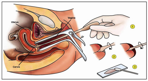 Papsmear Masih Awam di Kalangan Perempuan Indonesia 