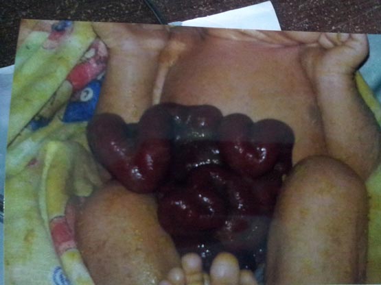 Bayi Lahir Usus di Luar Perut, Kasus Pertama Ditangani RSUD Meranti