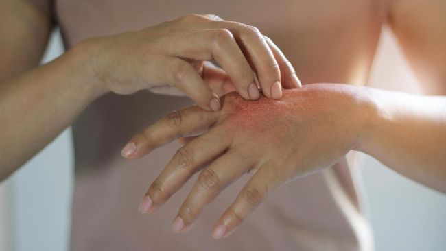 Mengenal Dermatitis Atopik, Penyakit Keturunan Seumur Hidup 