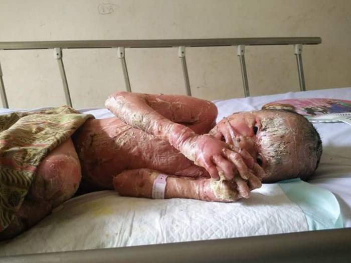 Ayo Bantu, Bocah 7 Tahun di Inhil Menderita Penyakit Langka dan Gizi Buruk 