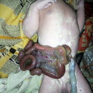 Bayi Asal Desa Belantaraya, Inhil Lahir dengan Usus di Luar 