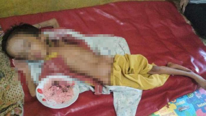 Dinkes Kampar Akan Bantu Pengobatan Firdaus