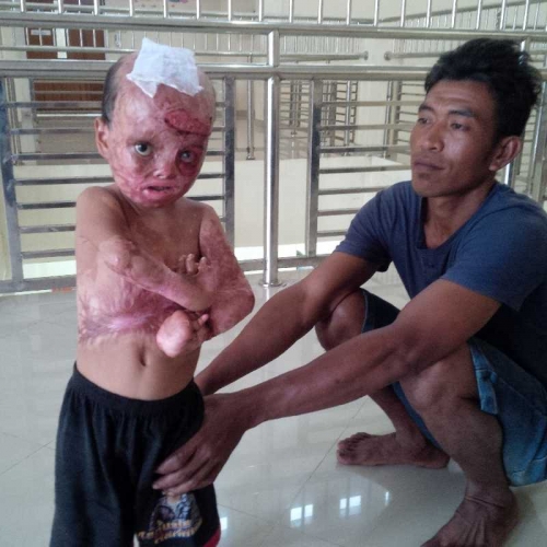 Kisah Reza, Bocah Kecil yang Melawan Maut Pasca Tubuhnya Terbakar 6 Bulan Lalu 