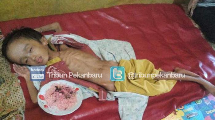 Alami Hidrosefalus, Dinkes Kampar Akan Berikan KIS Untuk Firdaus 