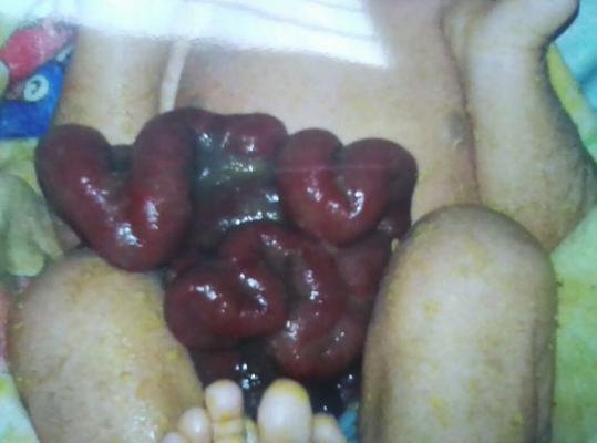 Bayi Lahir Usus di Luar Perut di Meranti Meninggal Dunia 