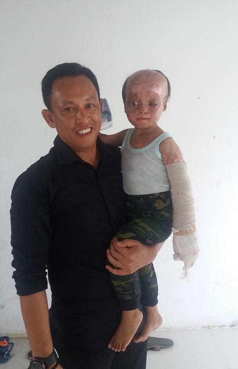 Alhamdulillah, Kondisi Reza Korban Kebakaran di Inhil Makin Membaik
