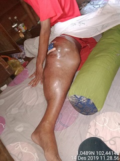 Dua Tahun Derita Kangker Ganas, Arifin Butuh Bantuan Dermawan