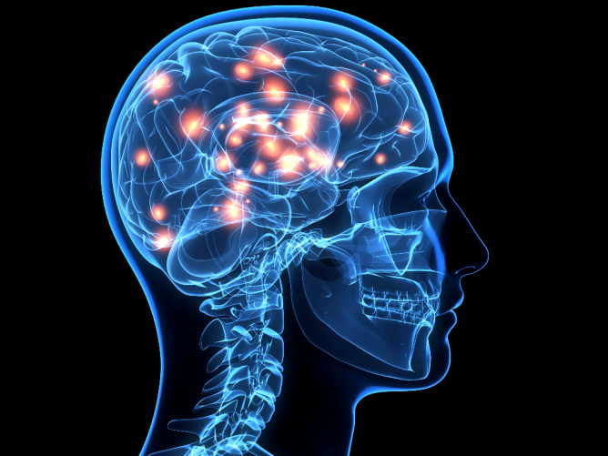 Stroke Bisa Terjadi Akibat Faktor Genetik