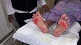 Kulit Melepuh Akibat Tak Pakai Alas Kaki, Ini Kata Dokter Kulit