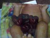 Bayi Lahir Usus di Luar Perut, Kasus Pertama Ditangani RSUD Meranti