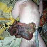 Bayi Asal Desa Belantaraya, Inhil Lahir dengan Usus di Luar