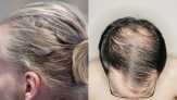 Waspada! Gaya Rambut Seperti Ini Picu Kebotakan Pria