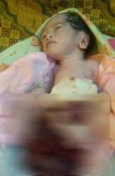 Bayi Malang Lahir dengan Lambung dan Usus Terburai Harapkan Uluran Tangan Dermawan
