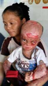 Akan Jalani Operasi Penempelan Daging di Wajah, Bocah Inhil yang Terbakar Memerlukan Biaya Besar
